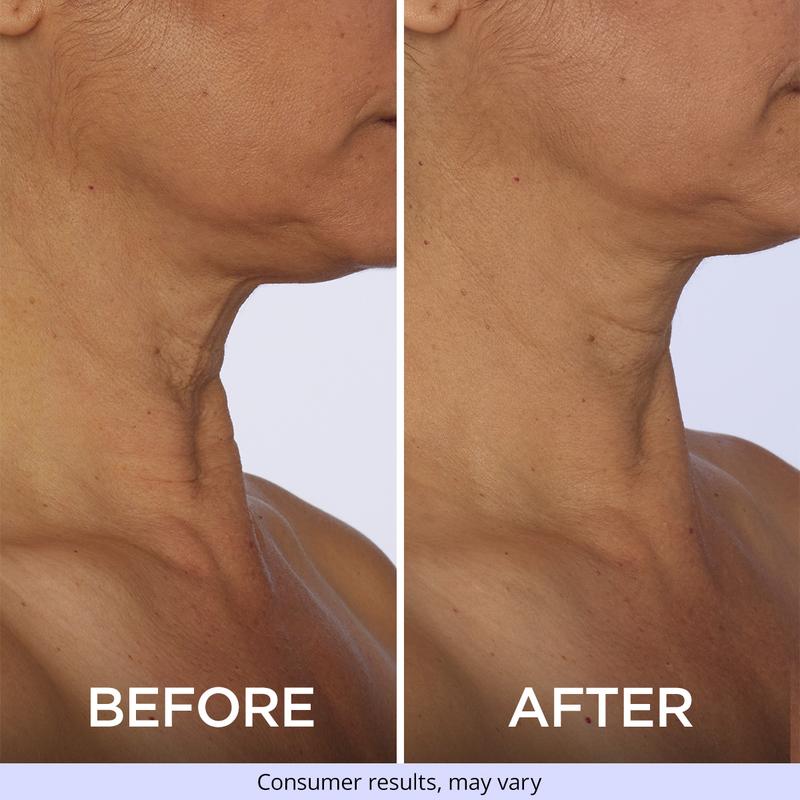 Moika™ Lissé Neck Renewal Cream